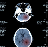 Nature Medicine：新的人工智能算法有助于检测脑瘤