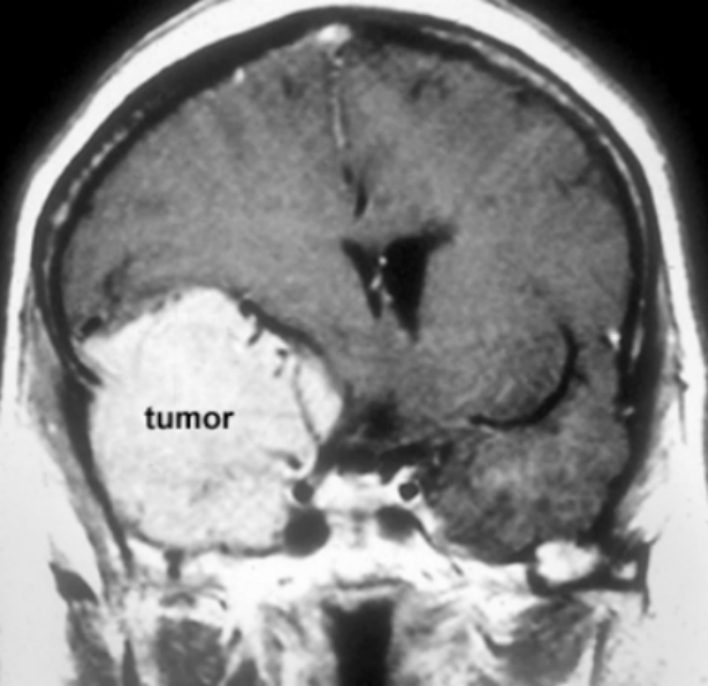 脑膜瘤5cm是几级？还有希望治好吗？