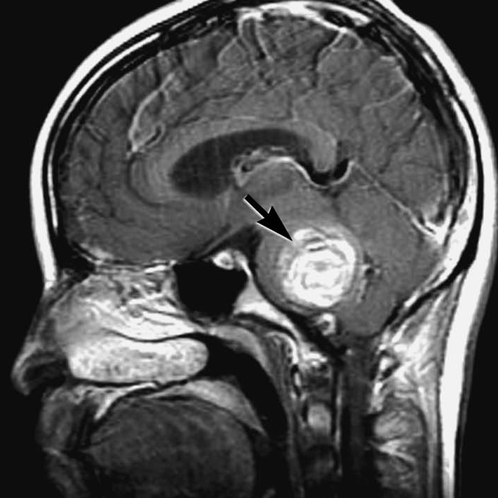 <a href='/qianyan/xueguanliu/' target='_blank'><u>脑干海绵状血管瘤</u></a>