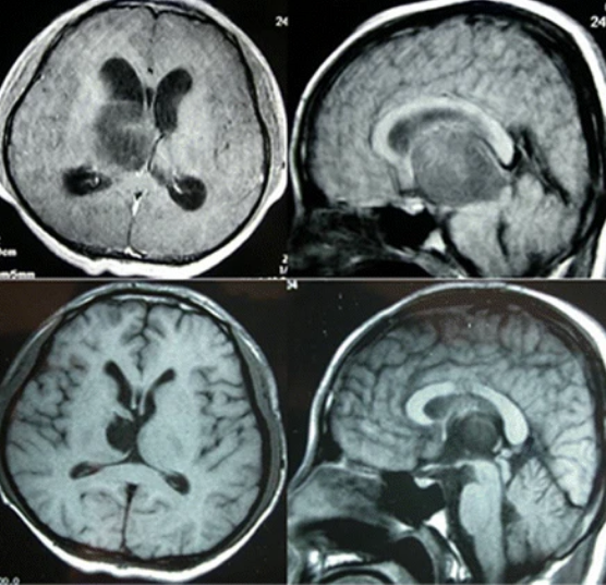 基底节区胶质瘤