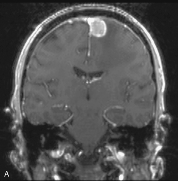 矢状窦旁脑膜瘤好治吗？顺利全切是脑膜瘤预后关键因素