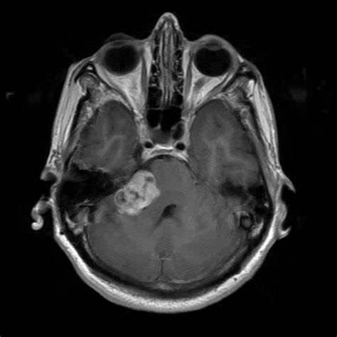 显微外科手术治疗听神经瘤患者的长期生活质量