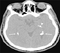 听觉性脑干植入帮助听神经瘤（神经纤维瘤II型）患者重获听力