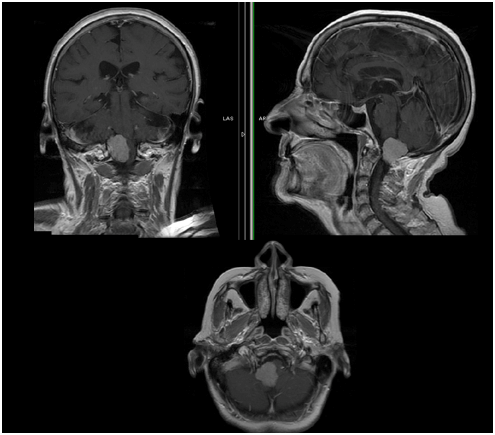 枕骨大孔区<a href='/qianyan/naozhongliu/' target='_blank'><u>脑肿瘤</u></a>