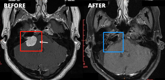 听神经瘤治疗前