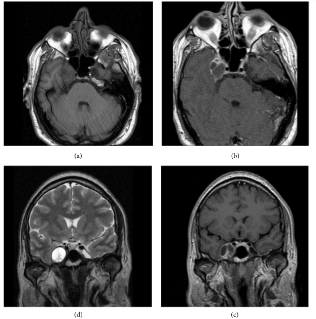 三叉神经鞘瘤再次复发怎么办?手术全切仍是主要目标
