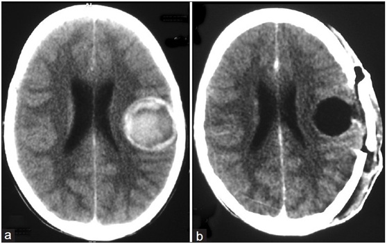 脑海绵状血管瘤