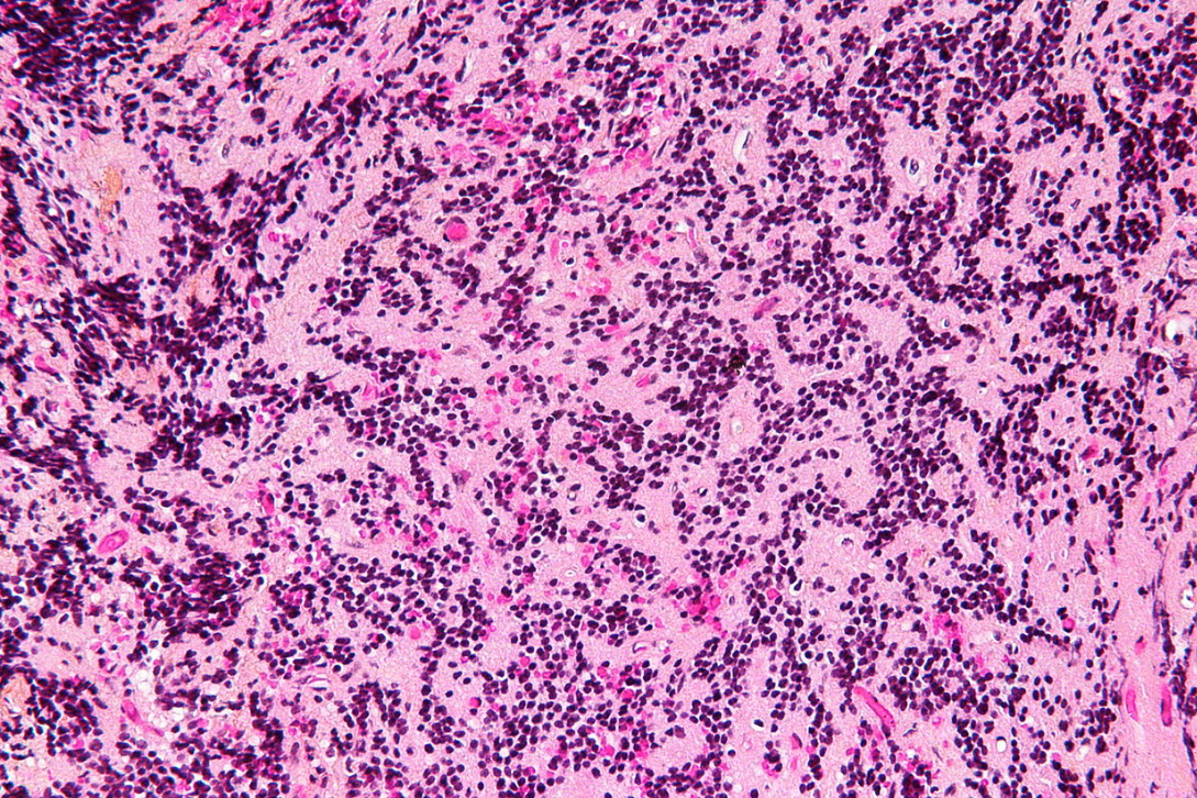 松果体细胞瘤治疗：有望治愈，手术难度较高