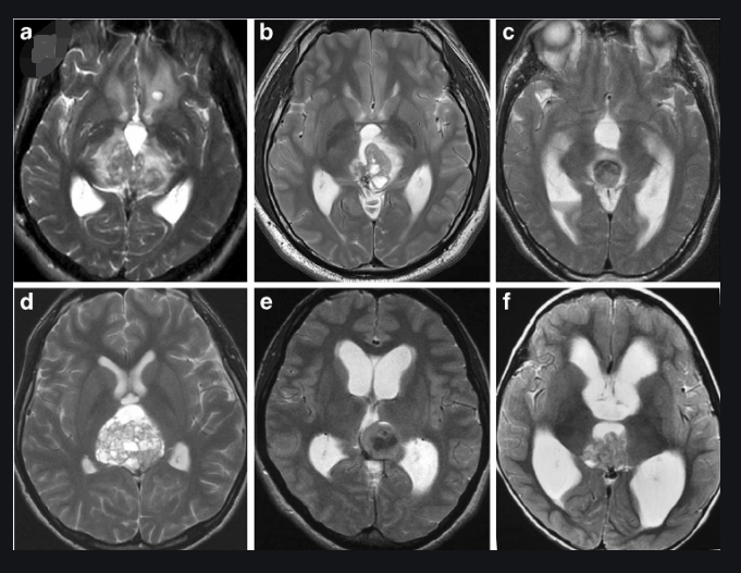 松果体区肿瘤案例
