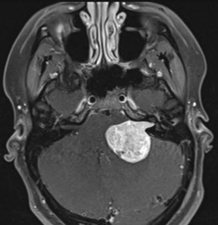 听神经瘤能治好吗？有哪些手术选择？