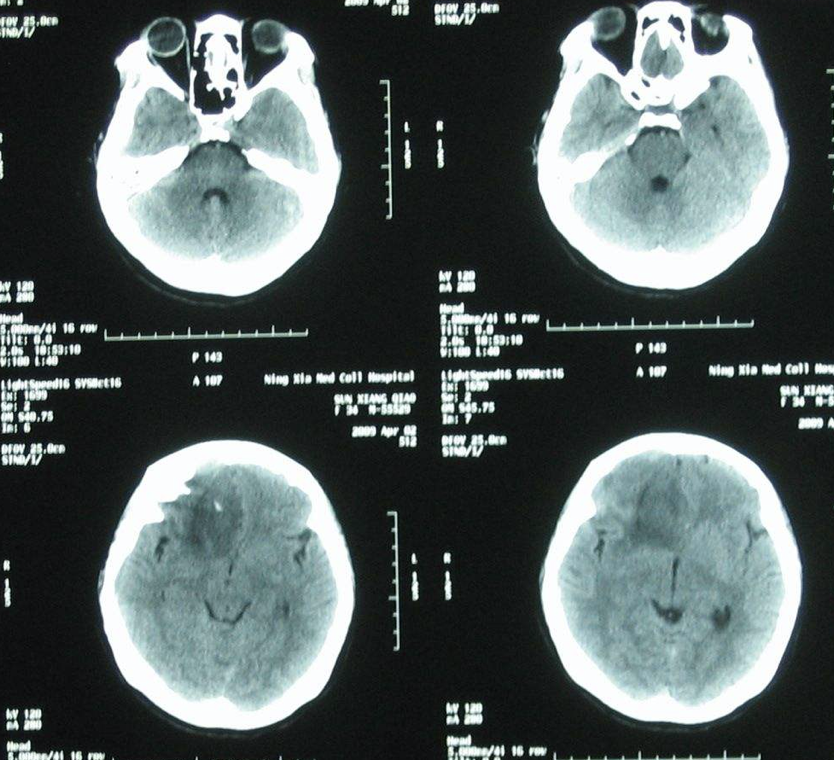 解密脑肿瘤：哪些是可以治愈的？