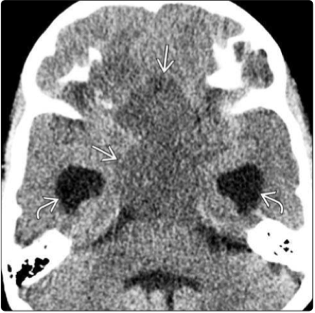 INC脑肿瘤科普|毛细胞星形细胞瘤是癌症吗？怎么治疗？