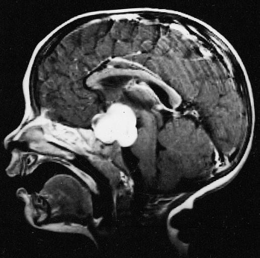 儿童星形细胞瘤的症状和治疗