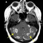 转移性脑瘤是什么？治疗策略如何抉择？