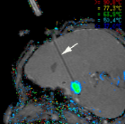 儿童癫痫怎么办？需要正确的诊断、药物和手术进行癫痫治疗
