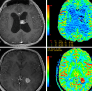 脑室肿瘤良性的多还是恶性的多?如何确诊？