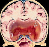 INC科普•脑瘤连载|毛黏液型星形细胞瘤