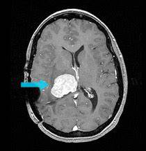 脑室内脑膜瘤