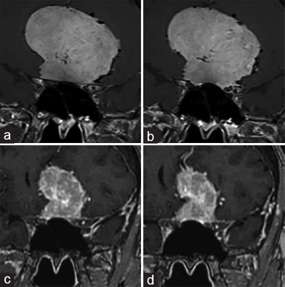 法国Froelich教授：醋酸环丙孕酮(CA)停用后，较大脑膜瘤减小且视力恢复