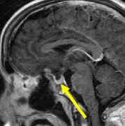 鞍结节脑膜瘤手术治疗新进展：神经内镜微创技术不断提高