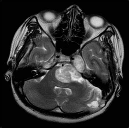 三叉神经鞘膜瘤如何治疗？分类不同手术方法不同