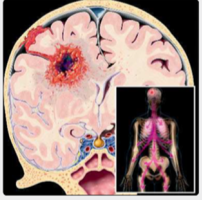 影像、尸检例证：胶质母细胞瘤转移的5种方式