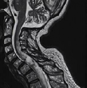 成人脊髓肿瘤的早期症状有哪些？