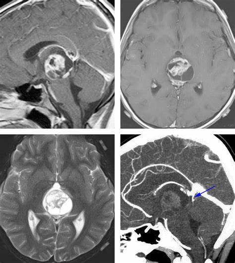 得松果体脑瘤的概率是多少？能不能长期生存？