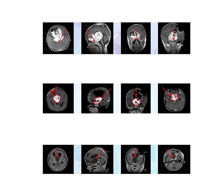 丘脑胶质瘤案例