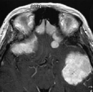 多发脑膜瘤性脑膜瘤严重吗？如何治疗？