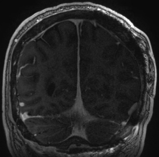 11*5cm复杂位置巨大脑膜瘤，记录手术全切全过程