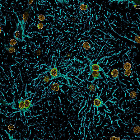 Cell Reports：实时成像揭示了浸润性胶质瘤细胞如何改变脑功能和血流