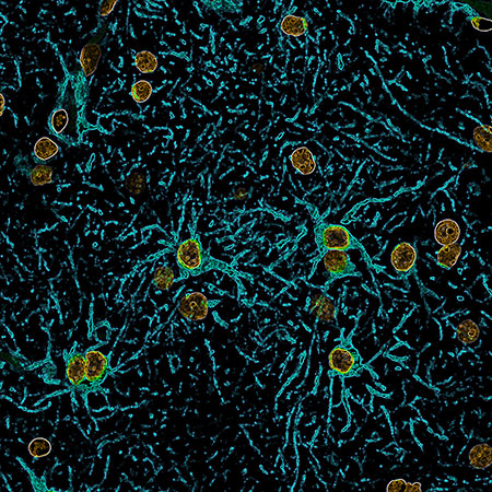 Cell Reports：实时成像揭示了浸润性胶质瘤细胞如何改变脑功能和血流