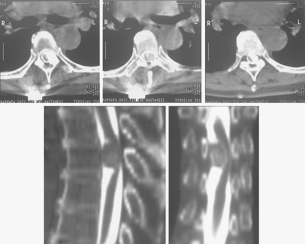 少见的脊髓脑膜瘤症状有哪些？如何治疗？