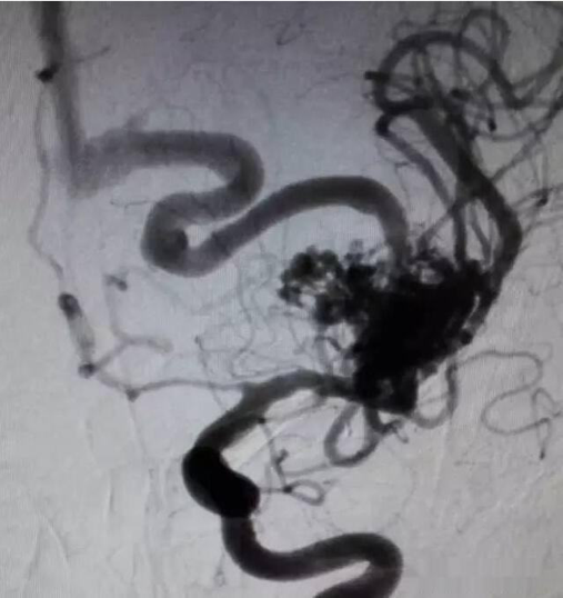 脑动静脉畸形AVM手术量破900例，INC美国Lawton教授个人记录再创新高