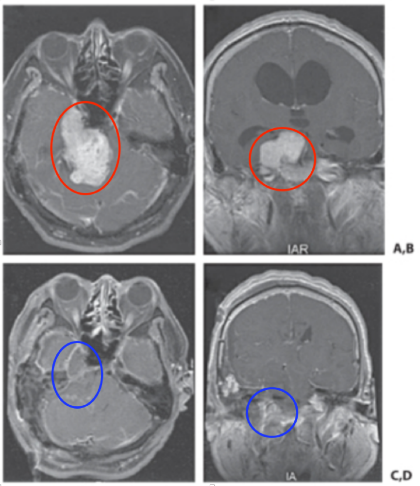 体积较大且邻近脑干的三叉神经鞘瘤能全切除吗？