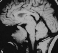 脊索瘤会复发吗?国外如何治疗?