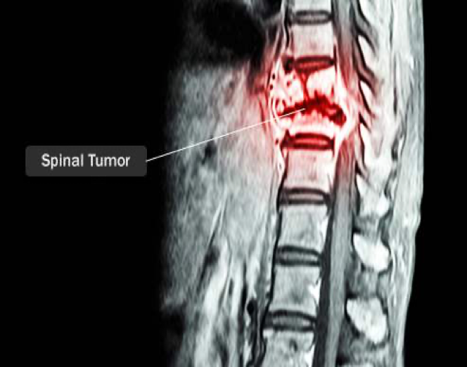 盘点脊髓肿瘤的常见类型
