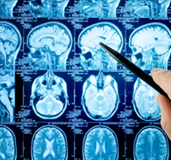 难治性癫痫的手术治疗：脑皮质切除术