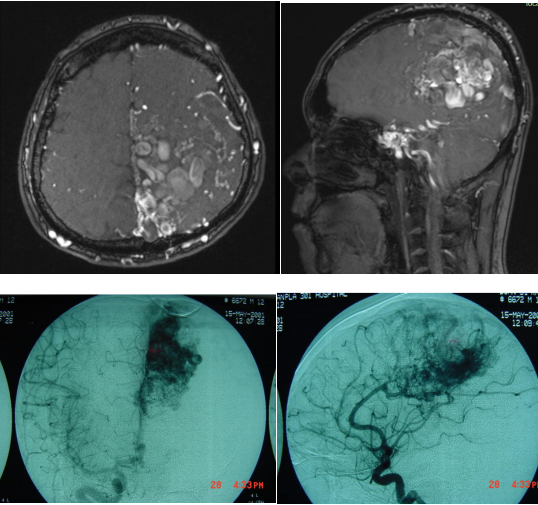 脑avm的治疗原则