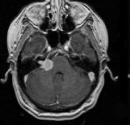 听神经瘤出国看病综合治疗及案例报告两则