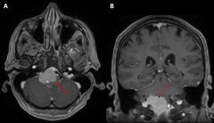 脑膜瘤不做手术可以吗？70岁女性斜坡脑膜瘤的延迟治疗案例报告