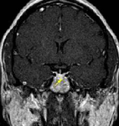 垂体瘤术后8大并发症