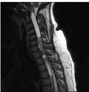 椎管内肿瘤（脊髓肿瘤）的分类和临床症状表现