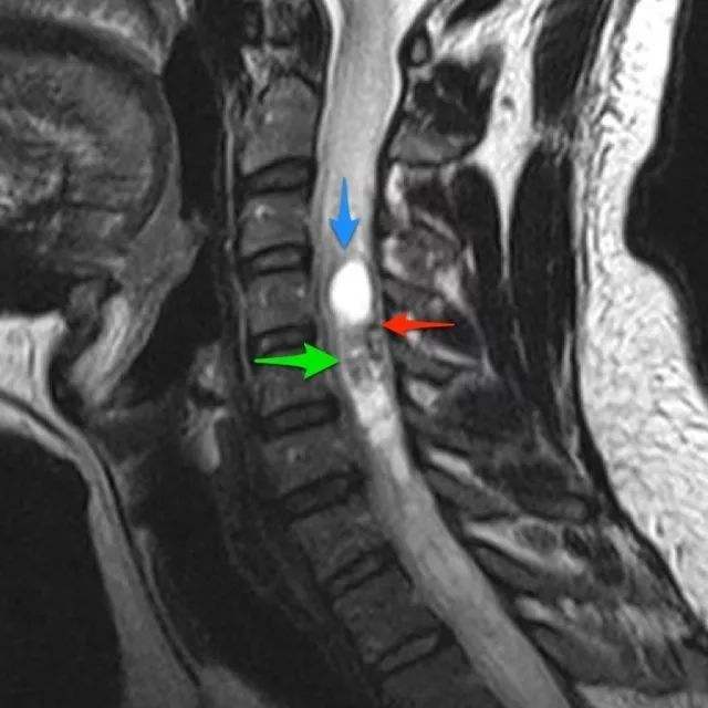 出国看病：脊髓肿瘤（椎管内肿瘤）的治疗及预后