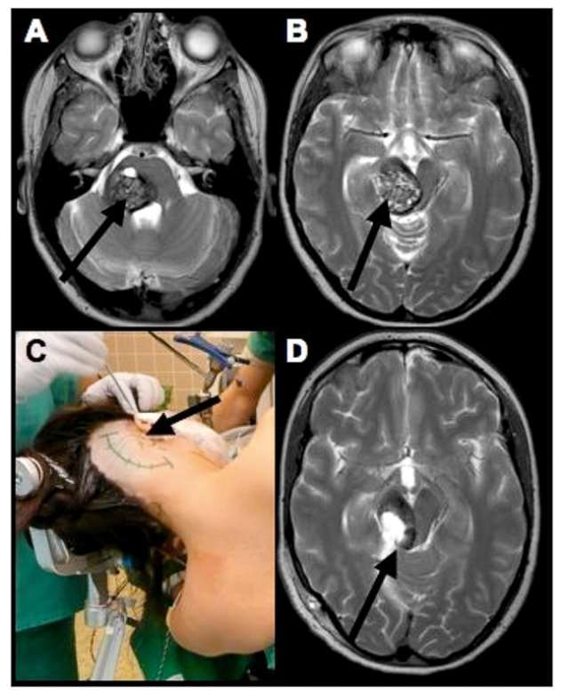 脑干海绵状血管瘤引起的脑干出血怎么办？