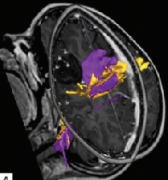 癫痫手术中神经导航及神经监测的使用