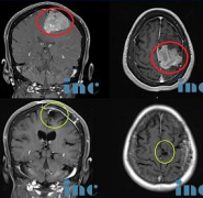 头晕持续3月不以为意一查竟是脑膜瘤