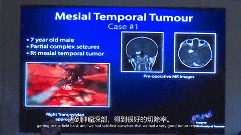 癫痫手术案例