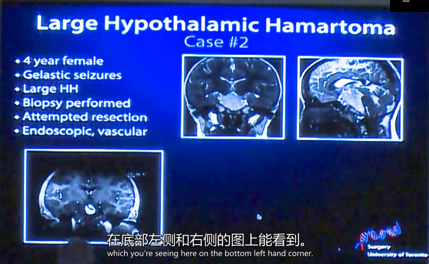 爱笑是一种病？药物难治性癫痫进行激光间质热疗LITT效果怎么样？